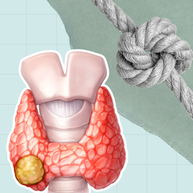 Фото Вузли щитоподібної залози: чи небезпечно? статті